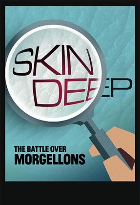 Skin Deep: The Battle Over Morgellons